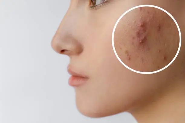 Liver Disease and Acne Treatment Research Converges on a Shared Metabolic Target